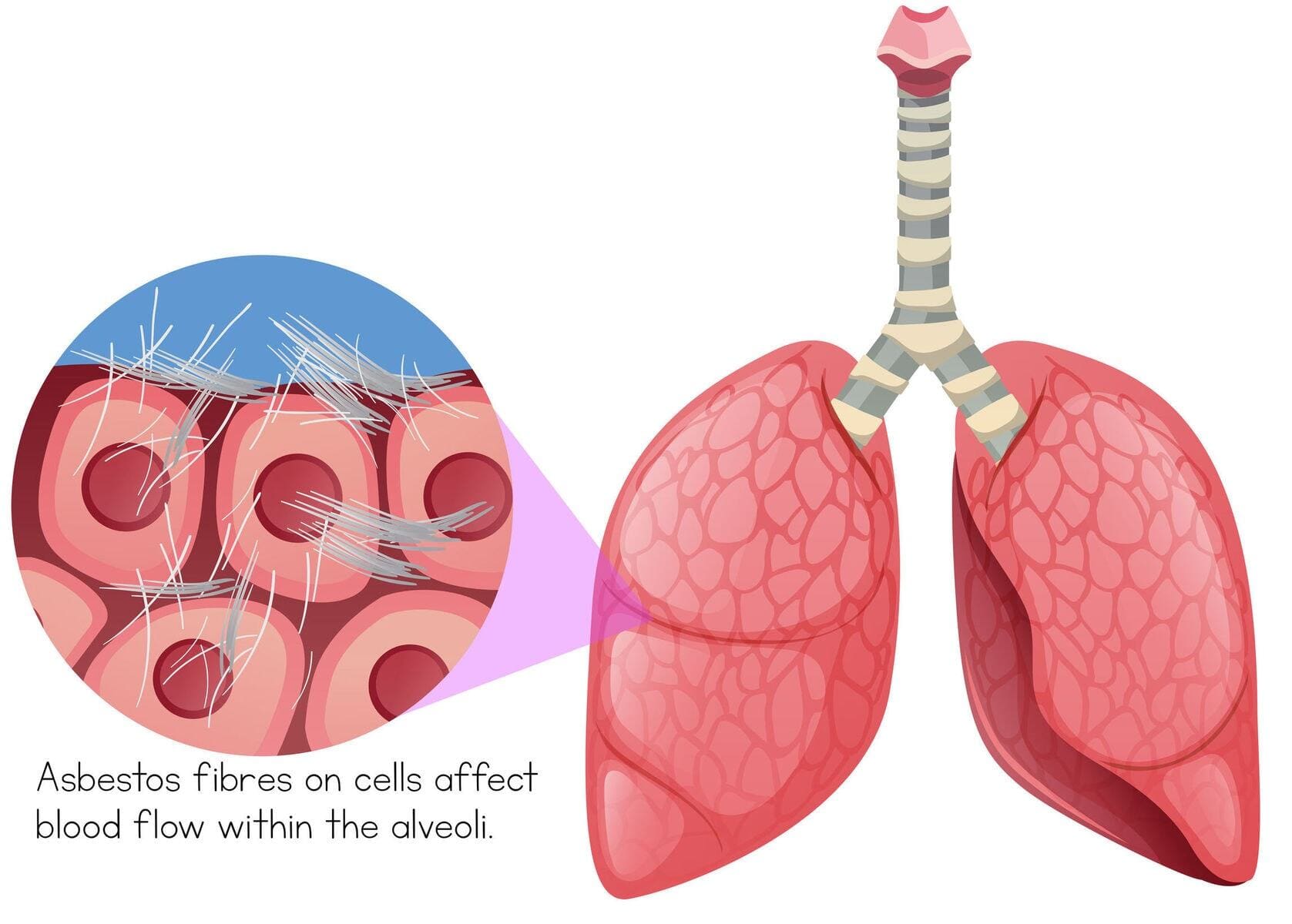 Asbestos Fibres on Cells Within Lungs - asbestosis